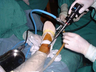 关节镜下清理术结合跟骨后隆突成形术治疗跟骨后滑囊炎